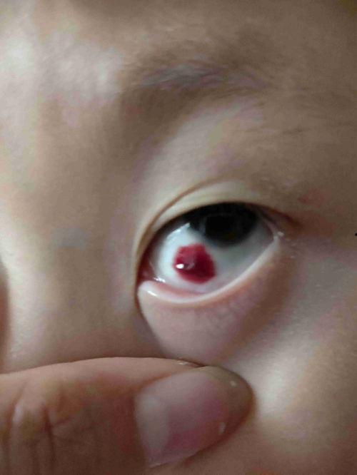 吃瓜吃豆眼早上肿