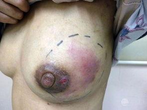 脓肿手术吃角瓜